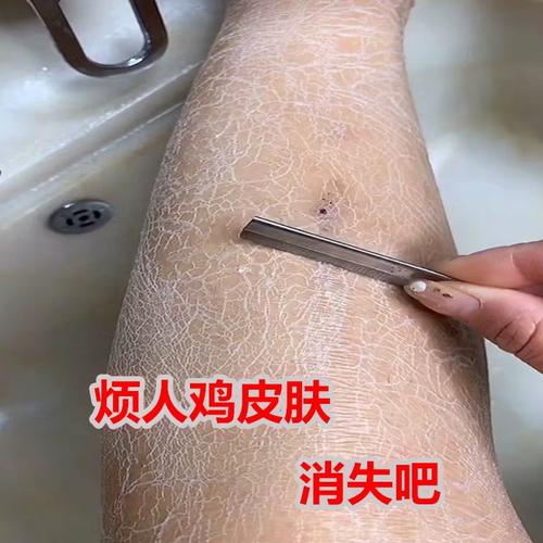 后背痘痘鸡皮疙瘩