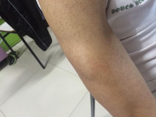 海边回来腿上起红点
