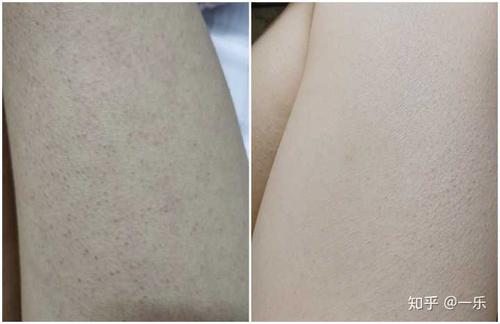 肉色丝袜能遮住鸡皮肤吗