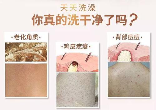 为什么后背会长鸡皮疙瘩