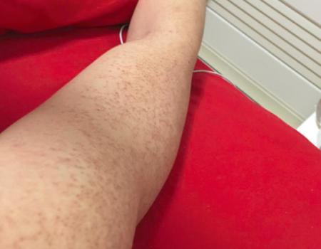 鼻子两侧长得类似鸡皮疙瘩的东西是什么