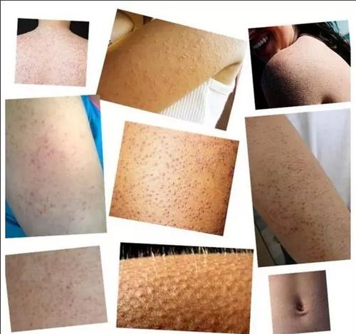 胸口长小鸡皮疙瘩